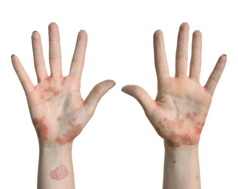 Psoriasis in den Händen